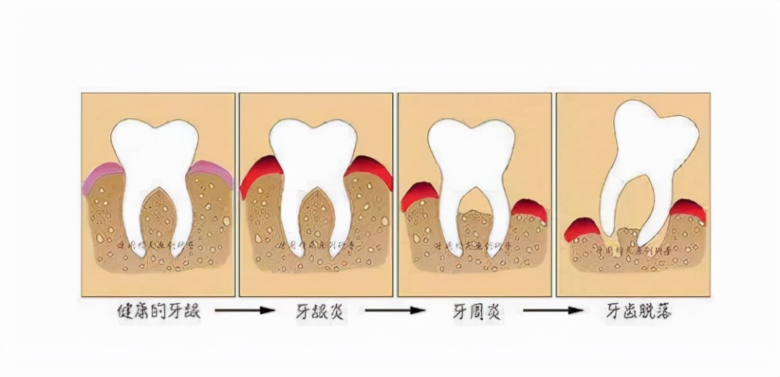 长期使用电动牙刷的危害，一直用电动牙刷刷牙好不好？