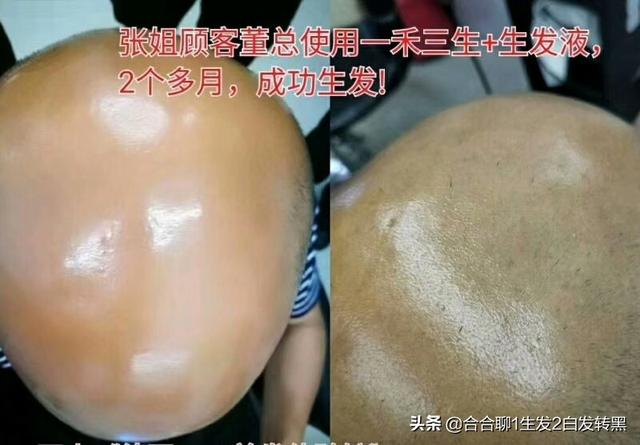 什么梳子防脱发，请问想防脱发用那种梳子好？