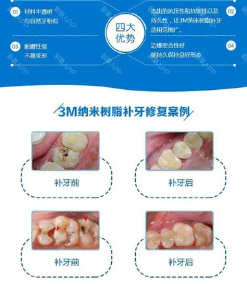 3m纳米树脂补牙价格 3m树脂保质期？3m纳米和3m250树脂区别？