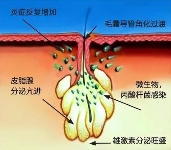 最好的祛痘面膜有哪些牌子？推荐几款祛痘最好的祛痘面膜？