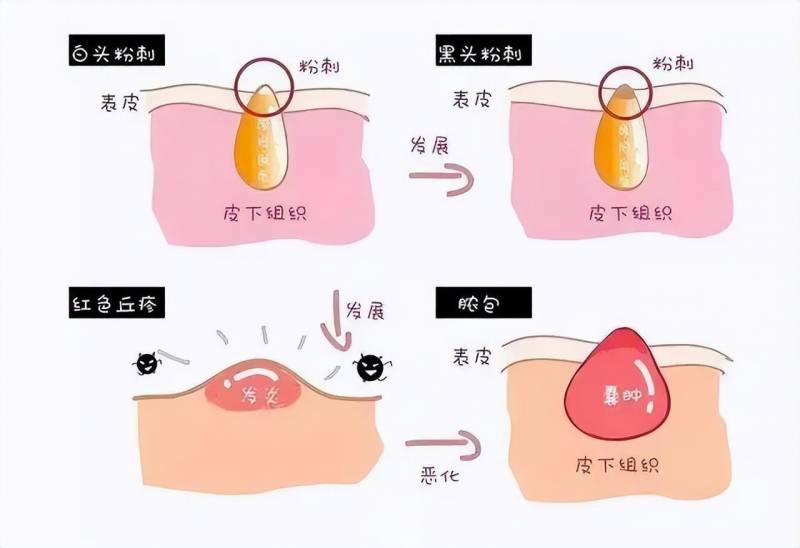 AN痘痘水怎么用？AN痘痘水孕妇可以用吗？